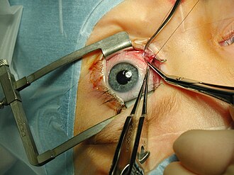 46m Nigerians grappling with preventable eye problems - Ophthalmologist